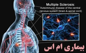 ستاگزانتین و بیماری ام اس Multiple Sclerosis (MS)